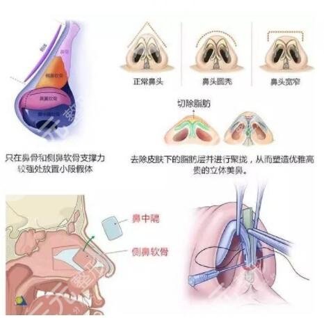 广州刘豪做的鼻子怎么样