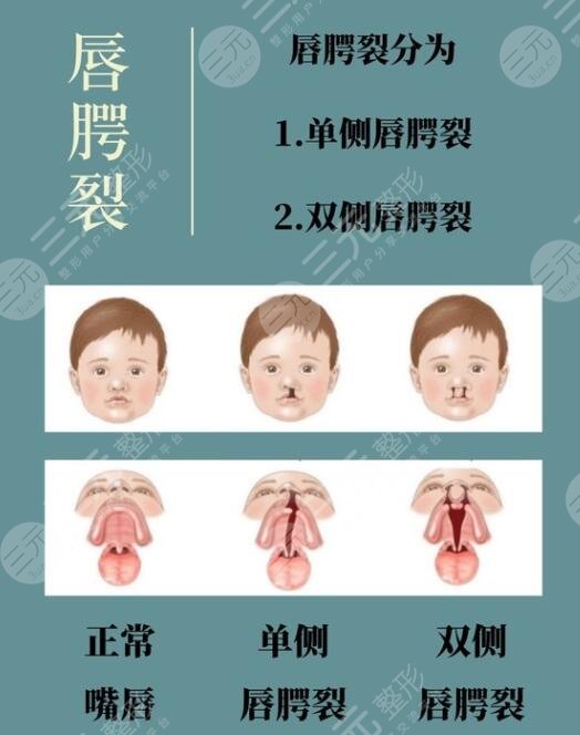 唇腭裂能完全修復(fù)好看不到痕跡嗎