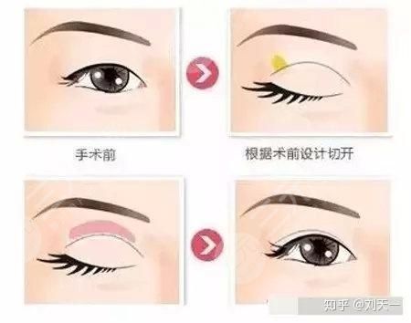 上海双眼皮修复专家