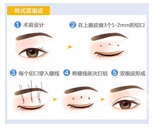 四川大学华西整形医院双眼皮怎么样