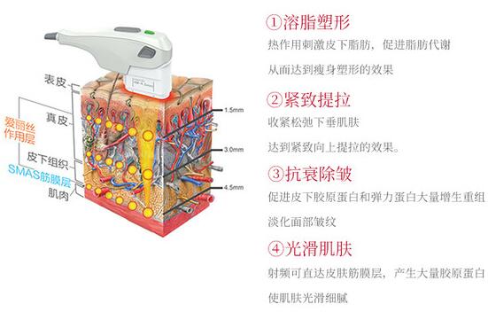 btl射频溶脂成好吗