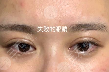 上海双眼皮修复厉害的医生全新揭晓