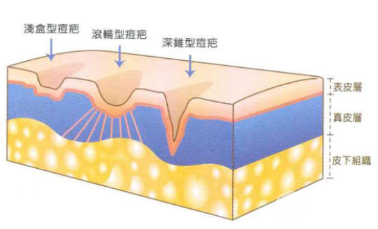 怎么去除痘印痘疤