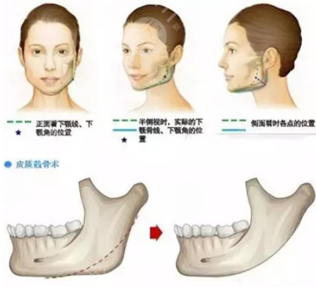 劉劍鋒下頜角做的怎么樣