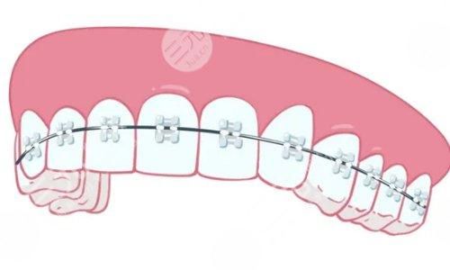 牙齒矯正用隱形牙套還是鋼絲牙套好