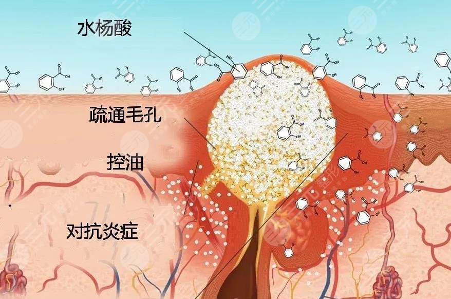 水楊酸的作用和危害你知道嗎