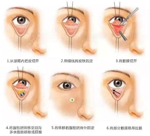深圳北大医院做眼袋手术怎么样