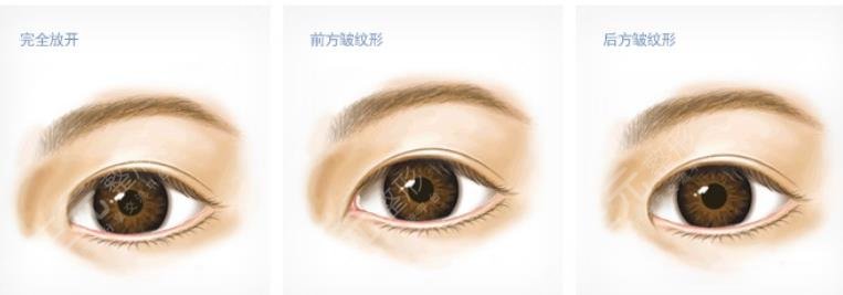 2022武汉割双眼皮医生排行更新