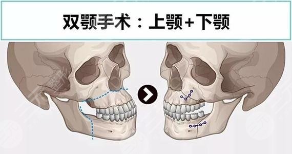 韓國(guó)做雙鄂手術(shù)好的醫(yī)院排名榜