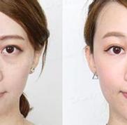 武漢美立方吸脂去眼袋有哪些優(yōu)點(diǎn)