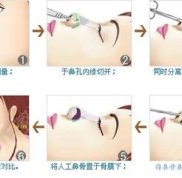 昆明鼻部綜合整形技術(shù)好的醫(yī)生前5排名公布