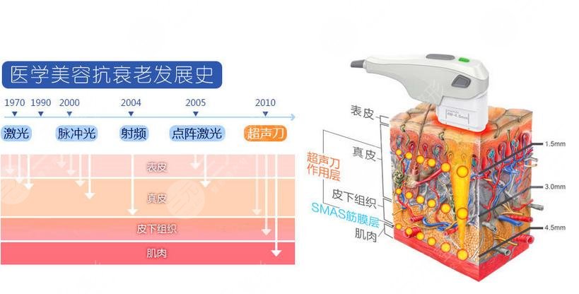 歐洲之星4d和超聲提拉的區(qū)別是什么