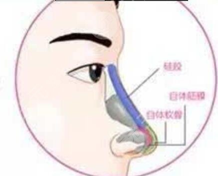 北京隆鼻手术医院推荐