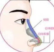 武漢新至美假體隆鼻調(diào)整俏挺水滴鼻