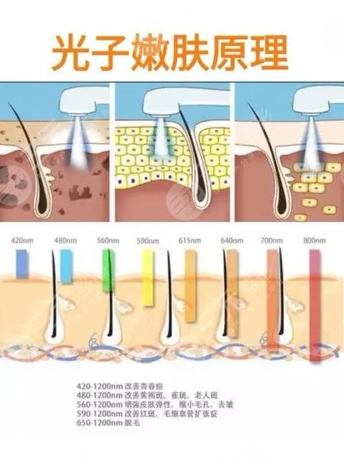 八大处光子嫩肤多少钱