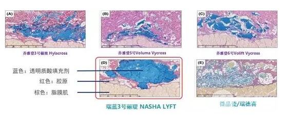 玻尿酸的“華山論劍”—瑞藍3號麗瑅PK喬雅登較好