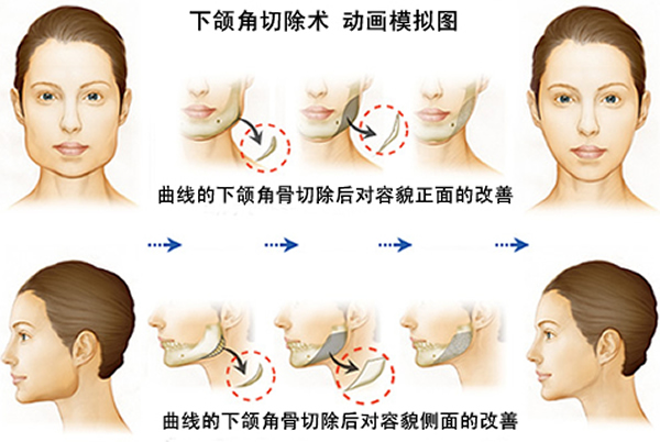 上海时光医疗美容医院下颌角手术怎么样