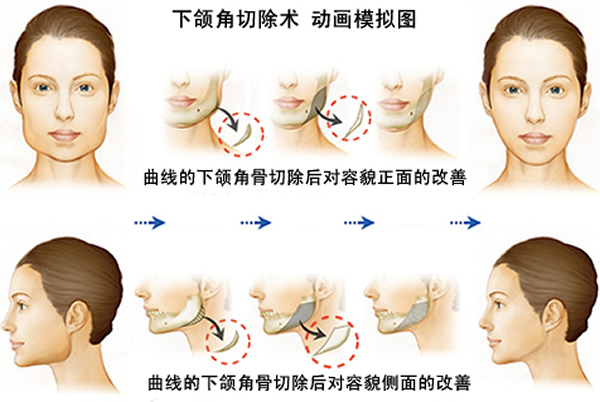 丹东第(一)医院下颌角手术价格是多少