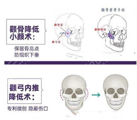 高占巍顴骨內(nèi)推怎么樣