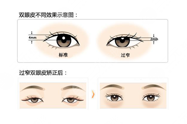 昆山時光趙春飛雙眼皮怎么樣