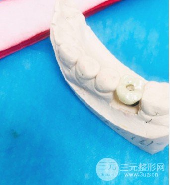 种植牙在北京大学口腔医院做的经历分享