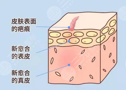 小欖人民醫(yī)院激光袪疤痕效果好嗎