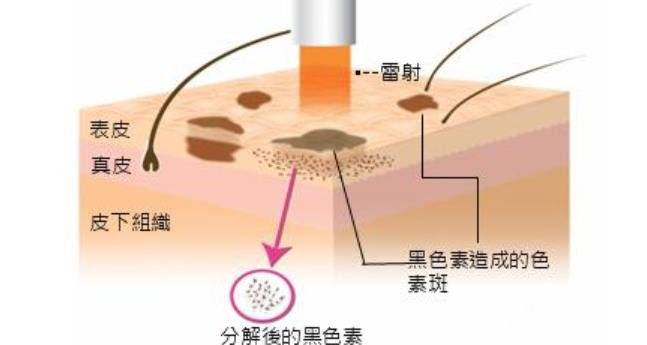 鐳射祛斑多少錢一次