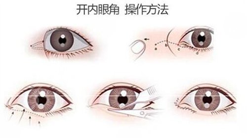 北京八大处双眼皮专家名单曝光