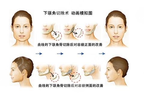 北京八大处下颌角手术分享