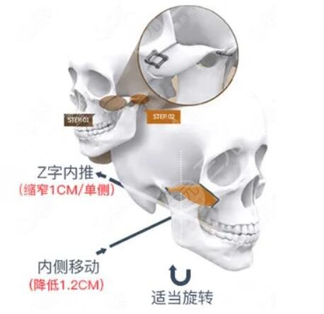 顴骨內(nèi)推手術(shù)全過(guò)程揭秘