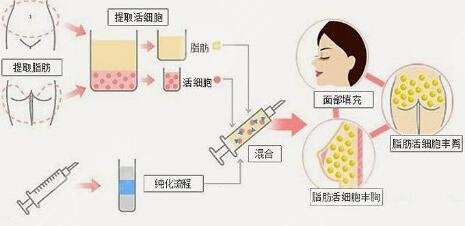 注射隆鼻的材料有哪些種類