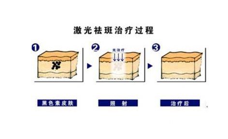 牛奶咖啡斑如何治疗