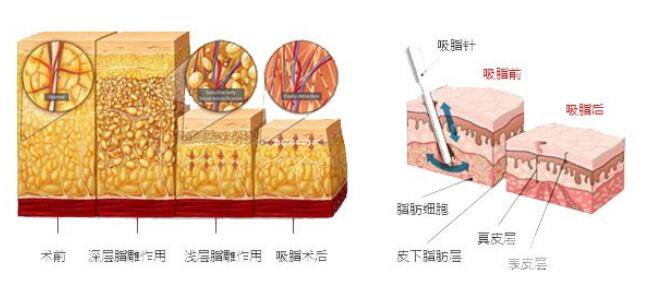 吸脂的方法有哪些