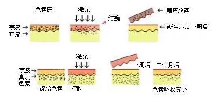 華山醫(yī)院激光效果怎么樣