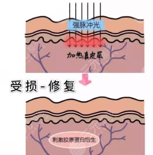 光子嫩肤祛痘印做几次才能看到果