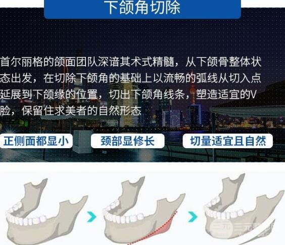 上海首尔丽格下颌角手术评价来咯