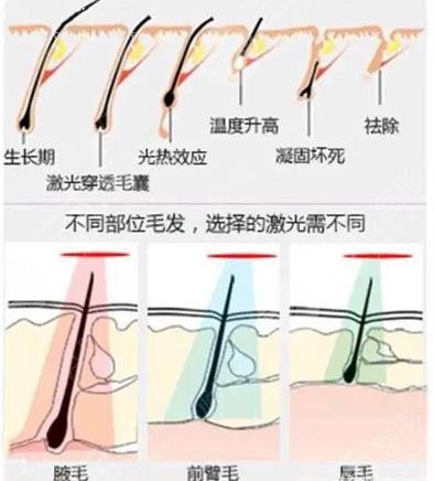 小欖人民醫(yī)院激光脫毛怎么樣