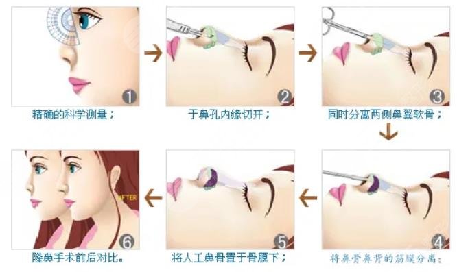 假體隆鼻后悔了多久可以取出