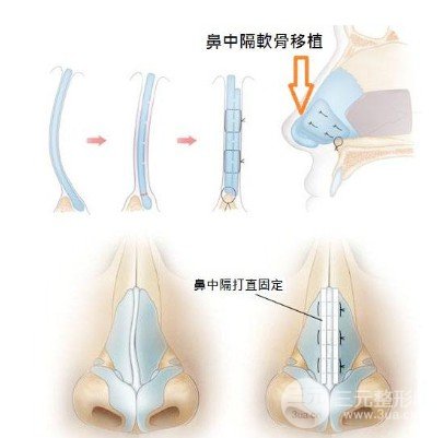 鼻子歪了怎么辦