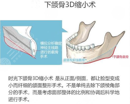 何晉龍和李志海磨骨區(qū)別是什么