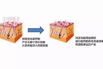 飛梭鐳射和點陣激光的區(qū)別有哪些