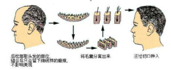 FUT還是FUE-哪種頭發(fā)移植適合你