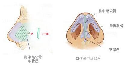 隆鼻整形多少錢一般