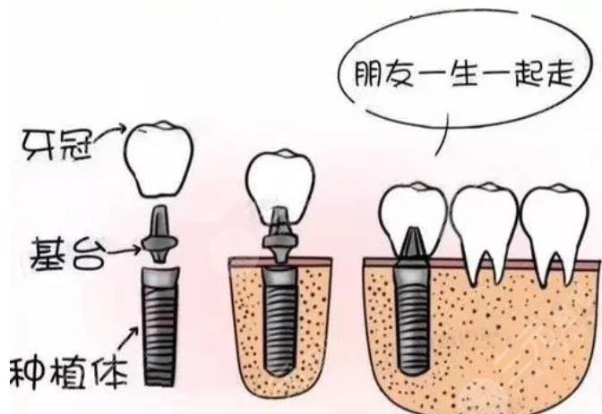 口碑好的种植牙牙科医院名单揭晓