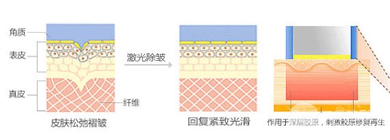 激光祛魚尾紋成好嗎