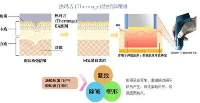 熱瑪吉緊膚除皺果怎么樣