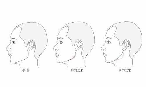 下頜角手術(shù)需要插尿管嗎