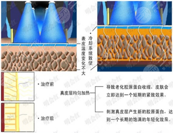 熱瑪吉緊膚除皺適應(yīng)人群