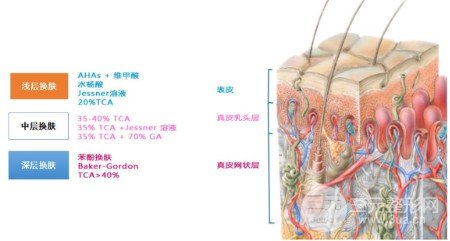 果酸煥膚果好不好