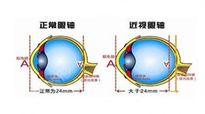 眼睛做激光手術有什么后遺癥